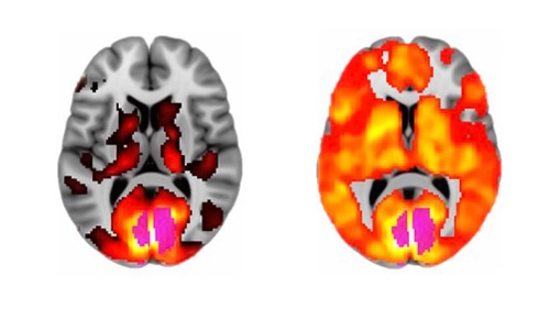 brain scan lsd